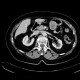GIST of stomach, gastrointestinal stomal tumour: CT - Computed tomography